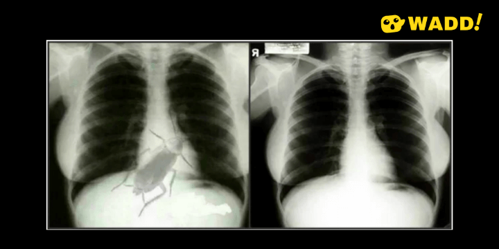 Debunked: Live Cockroach in Chest Xray is a doctored x-ray of Marilyn Monroe
